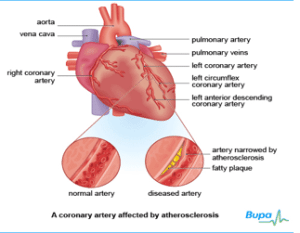 hipertenzija, koronarna bolest srca, i diastolický krvný tlak vysoký