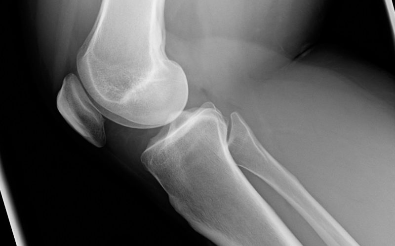 X-ray of knee with Chondromalacia condition, side view